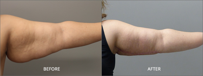 Arm Lift Surgery - Before and After