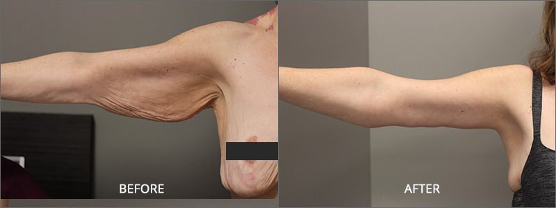 Arm Lift Surgery - Before and After