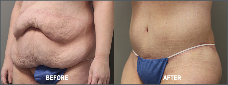 Female Belt Lipectomy Surgery - Before and After