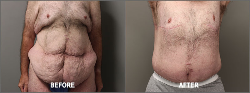 Male Belt Lipectomy Surgery - Before and After