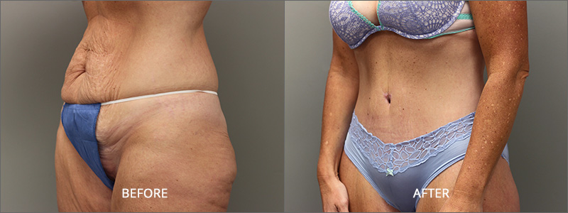 Female Belt Lipectomy Surgery - Before and After
