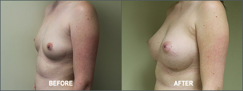 Breast Augmentation Surgery - Before and After