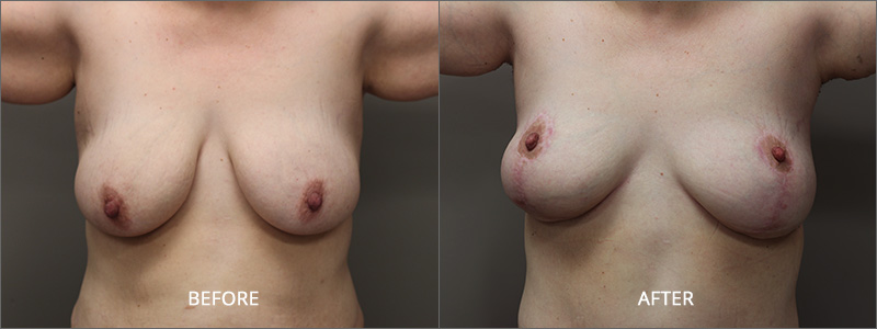 Breast Lift Surgery - Before and After