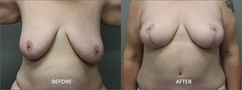 Breast Lift Surgery - Before and After