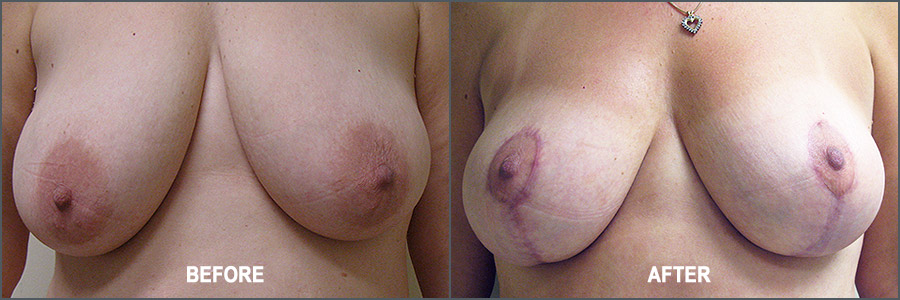 Breast Reduction Surgery - Before and After