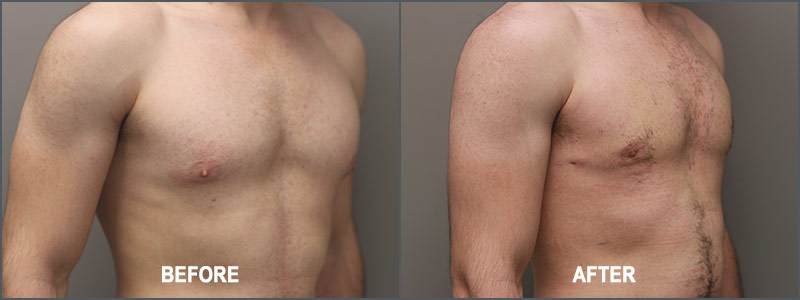 Gynecomastia Male Breast Reduction Surgery - Before and After