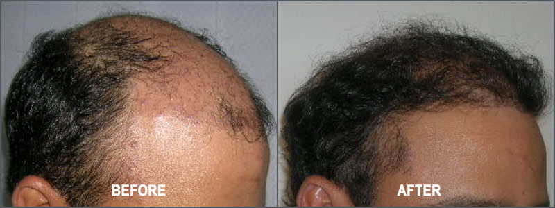 Hair Transplant Surgery - Before and After