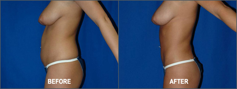 Liposuction Surgery - Before and After