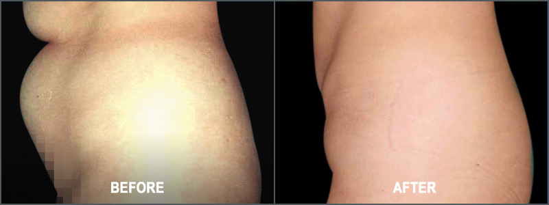 Liposuction Surgery - Before and After