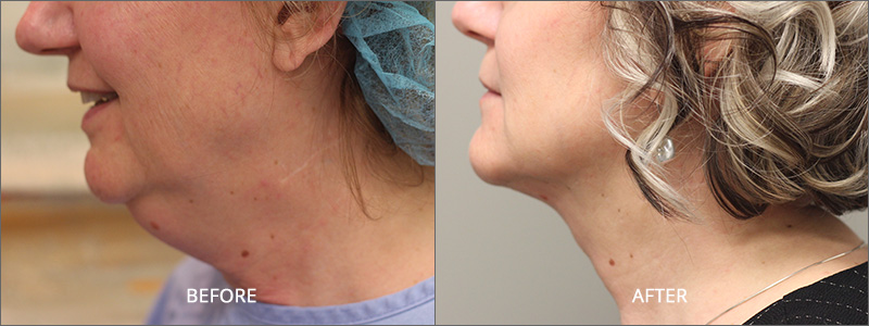 Neck Lift Surgery - Before and After