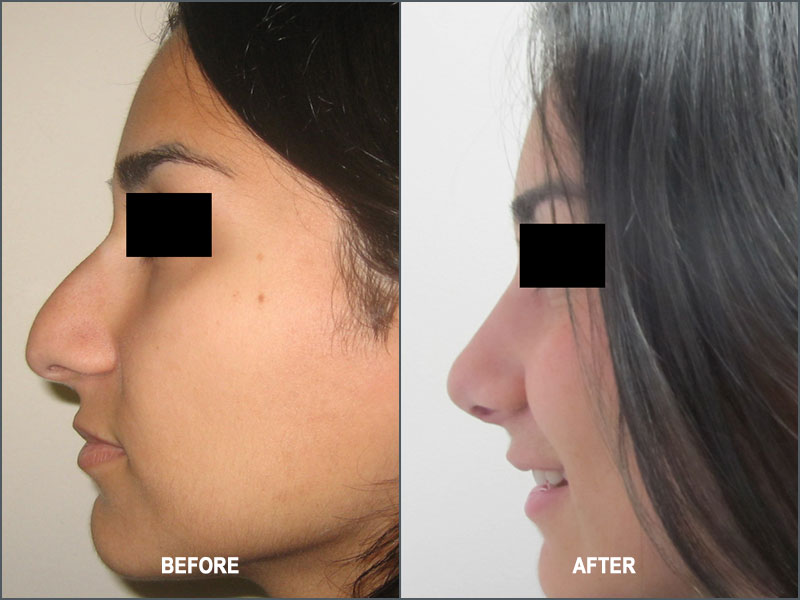 Rhinoplasty Surgery - Before and After