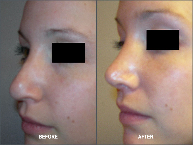 Rhinoplasty Surgery - Before and After