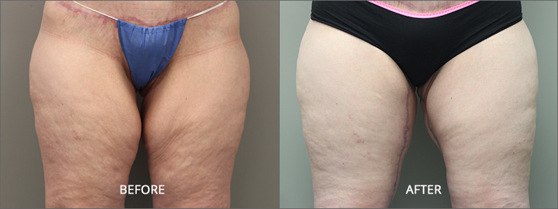 Thigh Lift Surgery - Before and After