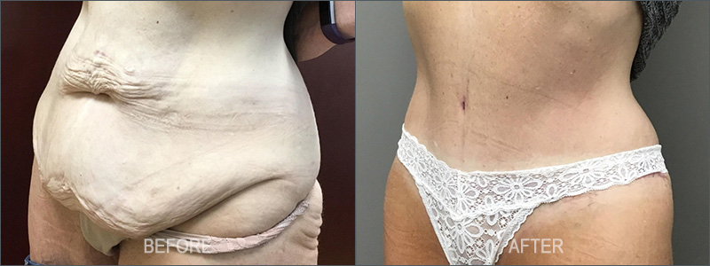 Tummy Tuck Surgery - Before and After