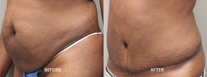 Tummy Tuck Surgery - Before and After